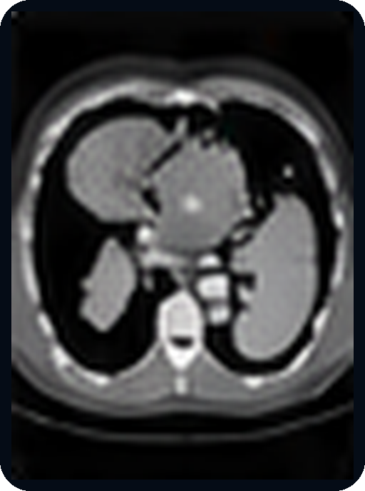 Examinare CT abdominală