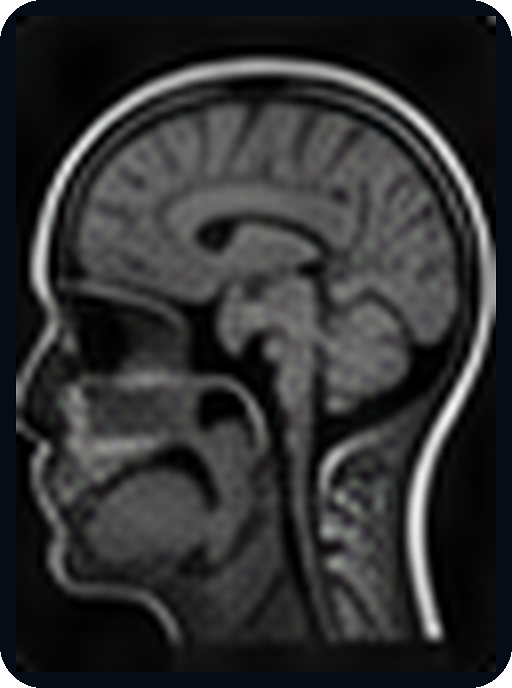 Examinare RMN cerebrală
